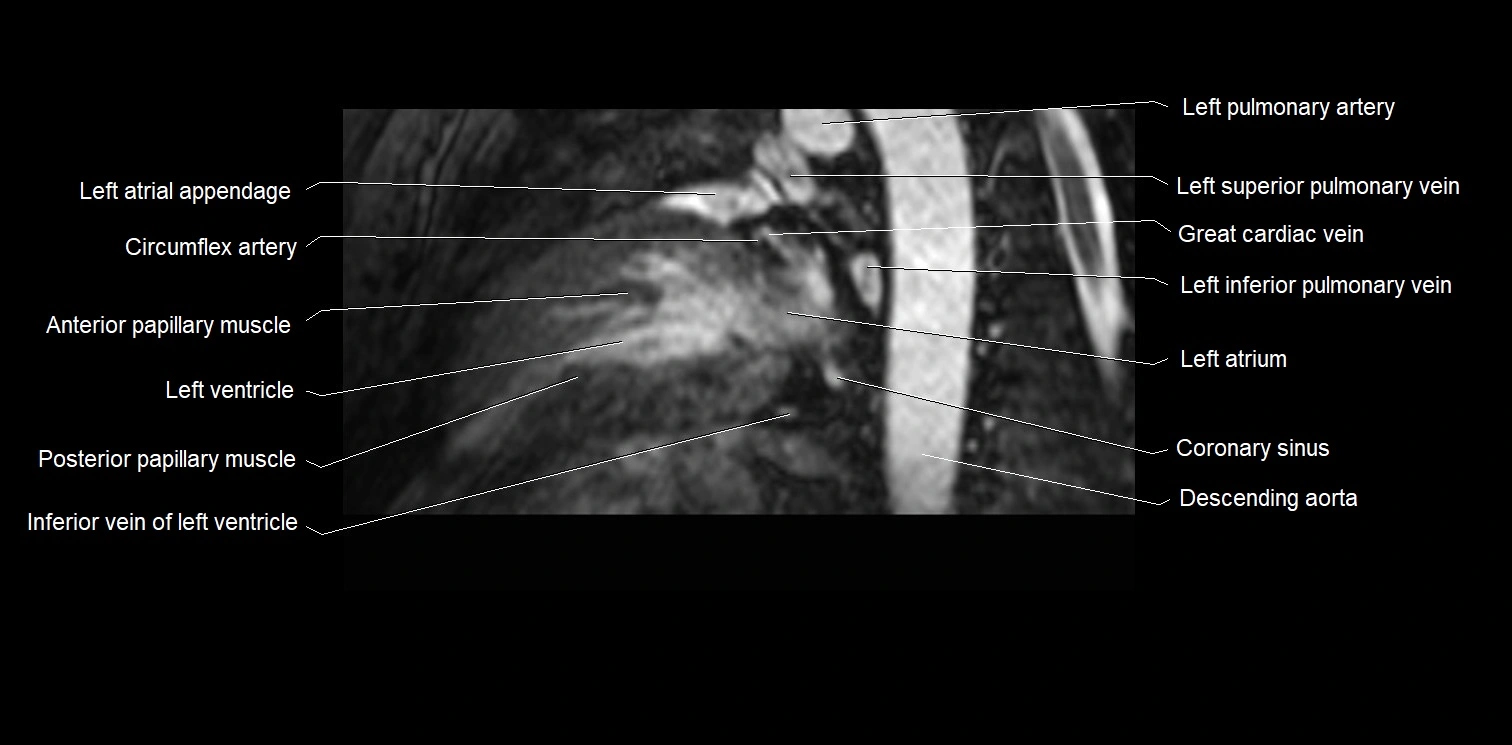 MRI heart and coronary arteries two chamber(sagittal)  anatomy image 33.webp